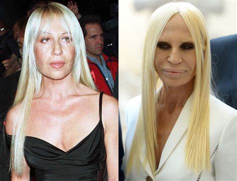 donatella versace facelift